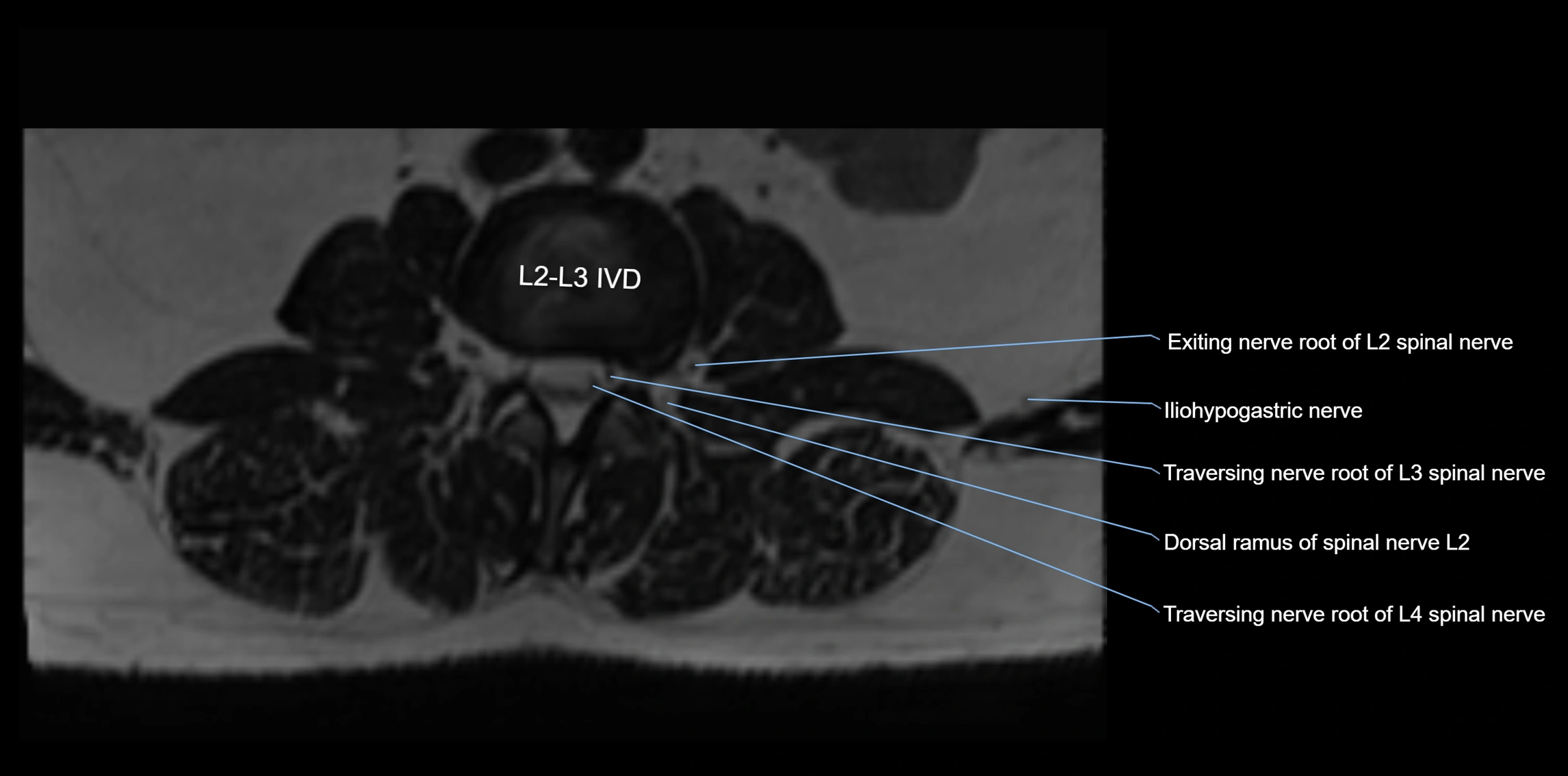 MR lumbosacral plexus axial cross sectional anatomy 3T  radiology  image-img-1008001-00012.webp